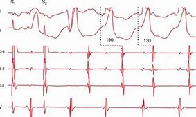 Image result for Atrioventricular Reciprocating Tachycardia