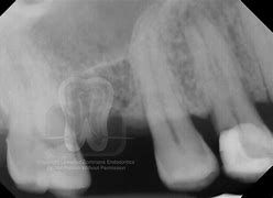 Image result for Root Canal Darkening