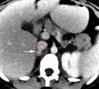 Image result for Pheochromocytoma CT Abdomen