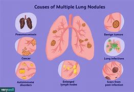 Image result for Multiple Lung Nodules