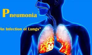 Image result for Pathogens Causing Pneumonia