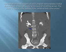 Image result for Retrocaval Ureter vs Normal