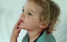 Image result for Baby Bed Bug Bites