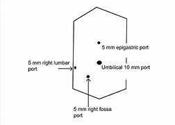 Image result for Ports for Lap Chole