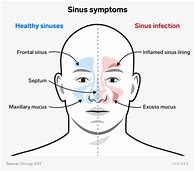 Image result for Sinus Infection Home Remedy