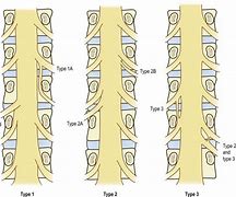 Image result for Spinal Nerves Lumbar Spine