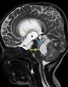 Image result for Medulloblastoma Location Diagram