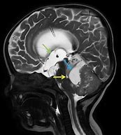 Image result for Neuropil Medulloblastoma