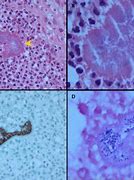 Image result for Actinomycetoma