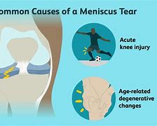 Image result for Meniscus Stress