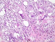 Image result for Necrosis Histology