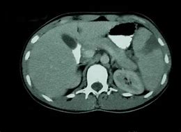 Image result for Spleen Enlargement CT