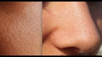 Image result for Open Nose Pores