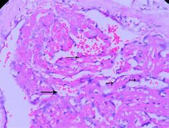 Image result for Organizing Thrombus Histology