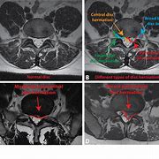 Image result for Abnormal Thoracic Spine MRI