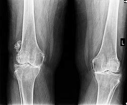 Image result for Posterior Knee Loose Bodies