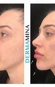 Image result for Chin Correction Filler