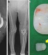 Image result for Left Knee Arthroplasty