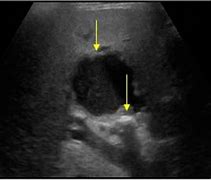 Image result for Biloma Ultrasound Images Post-Cholecystectomy