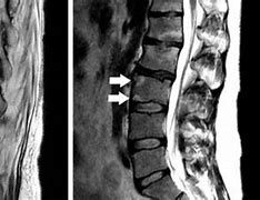 Image result for Lumbar Spine MRI 8Mm