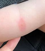 Image result for Baby Bed Bug Bites