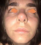 Image result for Swollen Inside Nose