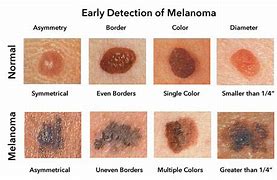 Image result for Skin Cancer Lower Back