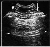 Image result for Pulmonary Regurg Ultrasound Flame