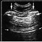 Image result for Pulmonary Regurg Ultrasound Flame