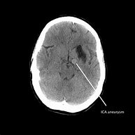 Image result for ICA Aneurysm