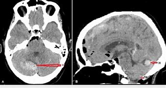 Image result for Orbital Hemorrhage CT