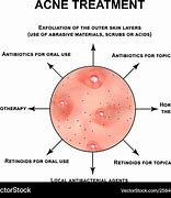 Image result for Large Acne Pustules