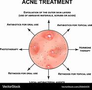 Image result for Pustules and Inflammatory Acne