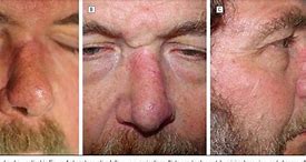 Image result for Dorsal Nasal Flap