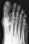 Image result for Broken Toe Bone