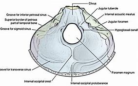 Image result for Extra-Axial Posterior Fossa Mass