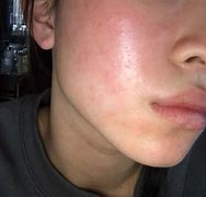 Image result for Itchy Face with Pimples