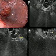 Image result for Biloma Ultrasound Images Post-Cholecystectomy