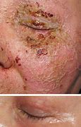 Image result for Pustules On Forehead