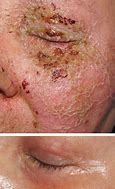 Image result for Pustules and Papules On Face