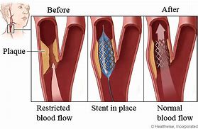 Image result for Carotid Artery Stenting