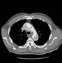 Image result for Aortic Rupture CXR