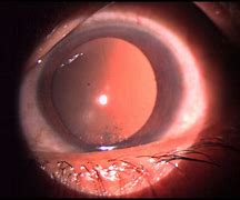 Image result for HLA Gene Uveitis