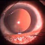 Image result for HLA Gene Uveitis