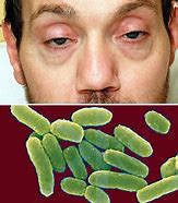 Image result for Botulism