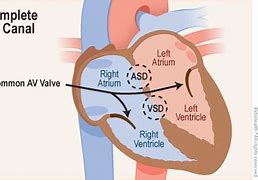 Image result for AV Canal Defect Down Syndrome