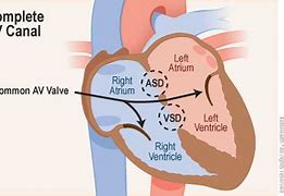 Image result for Tof with Atrioventricular Canal Defect