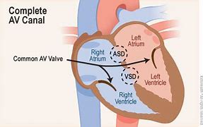 Image result for Complete Atrioventricular Canal Defect