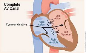 Image result for Unbalanced AV Canal