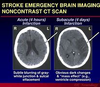 Image result for Acute Stroke